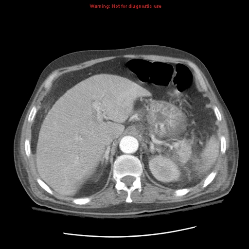 Acute pancreatitis with incidental pancreatic lipoma (Radiopaedia 10190-10730 Axial C+ arterial phase 27).jpg