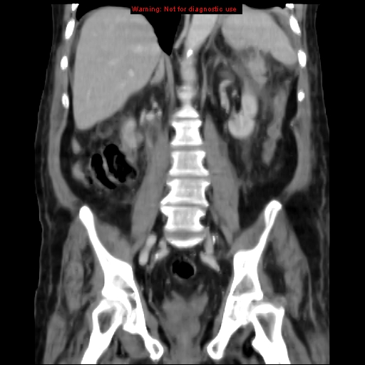 Acute pancreatitis with incidental pancreatic lipoma (Radiopaedia 10190-10730 Coronal C+ portal venous phase 45).jpg