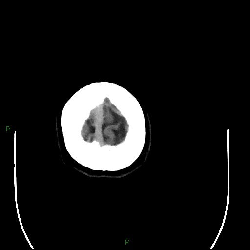 File:Acute posterior cerebral artery territory infarct (Radiopaedia 79329-92393 Axial non-contrast 107).jpg