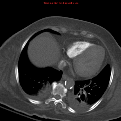 Acute pulmonary embolism (Radiopaedia 13286-13289 Axial C+ CTPA 49).jpg