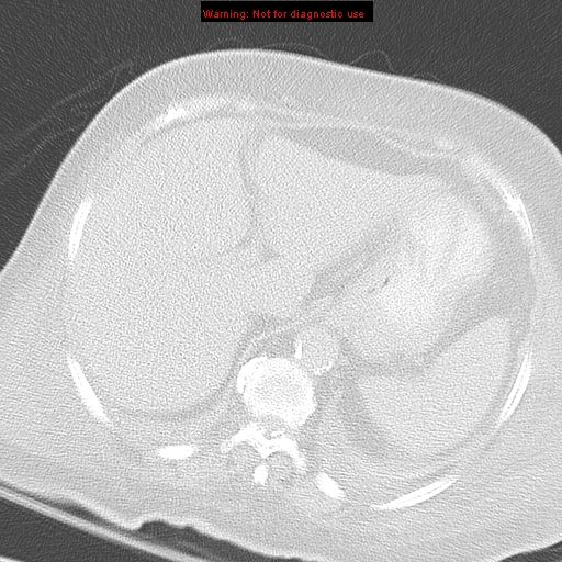 File:Acute pulmonary embolism (Radiopaedia 13286-13289 B 39).jpg