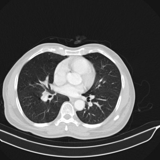 Acute pulmonary embolism (Radiopaedia 69510-79390 Axial lung window 33).jpg
