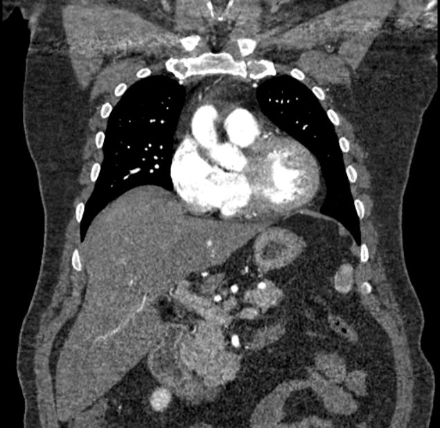 Acute pulmonary embolism with pulmonary infarcts (Radiopaedia 77688-89908 Coronal C+ CTPA 23).jpg