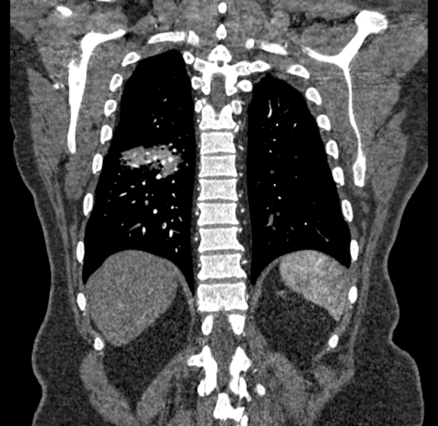 Acute pulmonary embolism with pulmonary infarcts (Radiopaedia 77688-89908 Coronal C+ CTPA 82).jpg