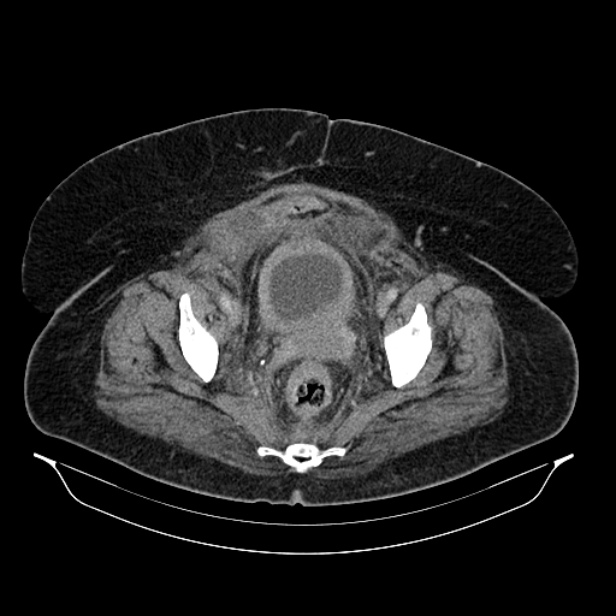 Acute pyelonephritis (Radiopaedia 25657-25837 Axial renal parenchymal phase 70).jpg