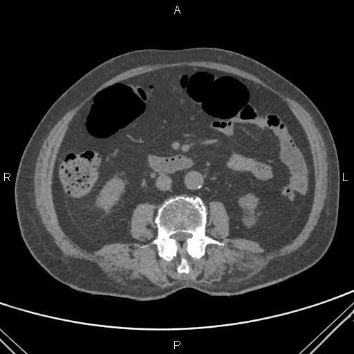 File:Acute renal artery occlusion (Radiopaedia 86586-102682 Axial non-contrast 41).jpg