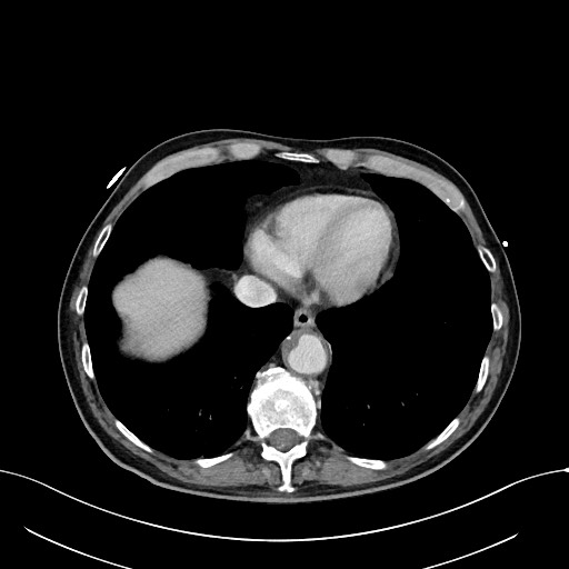 Acute renal infarction (Radiopaedia 59375-66736 Axial C+ portal venous phase 5).jpg