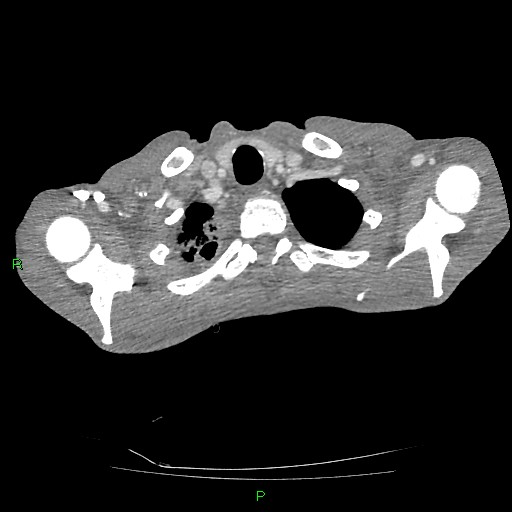 File:Acute right lung abscess (Radiopaedia 34806-36258 Axial C+ arterial phase 12).jpg