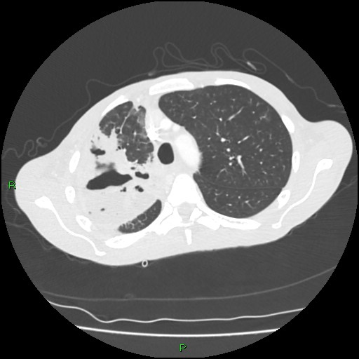 Acute right lung abscess (Radiopaedia 34806-36258 Axial lung window 49).jpg