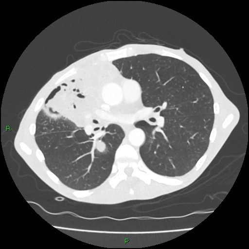 Acute right lung abscess (Radiopaedia 34806-36258 Axial lung window 95).jpg