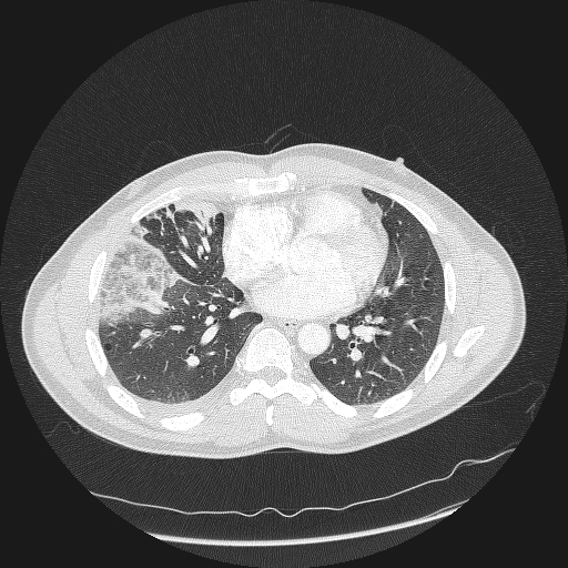 Acute segmental pulmonary emboli and pulmonary infarction (Radiopaedia 62264-70444 Axial lung window 116).jpg