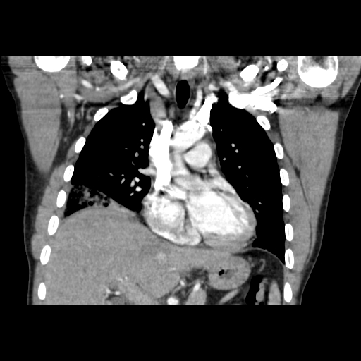 Acute segmental pulmonary emboli and pulmonary infarction (Radiopaedia 62264-70444 Coronal C+ CTPA 21).jpg