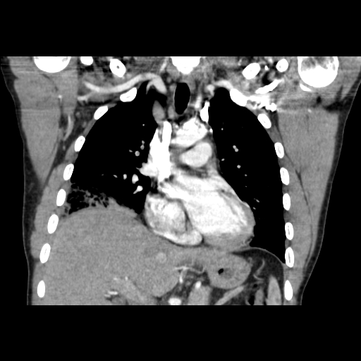 Acute segmental pulmonary emboli and pulmonary infarction (Radiopaedia 62264-70444 Coronal C+ CTPA 22).jpg