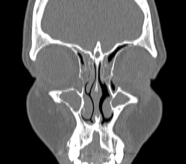 File:Acute sinusitis (Radiopaedia 40564-43158 Coronal bone window 8).jpg