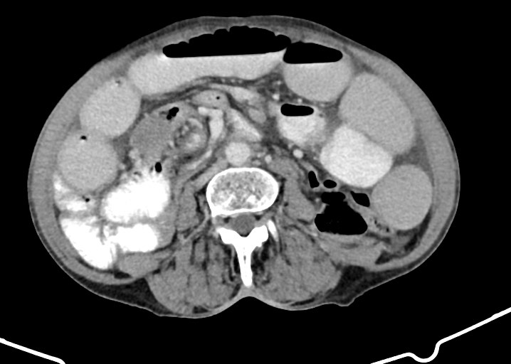 Acute small bowel (ileal) volvulus (Radiopaedia 71740-82139 Axial C+ portal venous phase 115).jpg