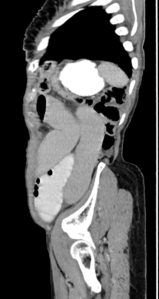 Acute small bowel (ileal) volvulus (Radiopaedia 71740-82139 Sagittal C+ portal venous phase 39).jpg