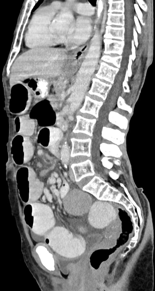 Acute small bowel (ileal) volvulus (Radiopaedia 71740-82139 Sagittal C+ portal venous phase 86).jpg