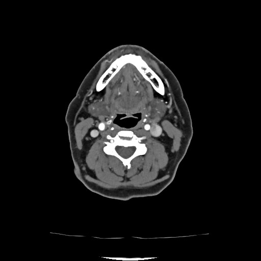File:Acute subarachnoid hemorrhage and accessory anterior cerebral artery (Radiopaedia 69231-79009 Axial C+ arterial phase 53).jpg