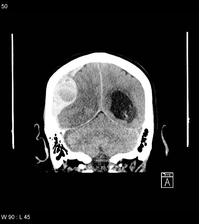 Acute subdural hematoma with myelofibrosis (Radiopaedia 52582-58494 Coronal non-contrast 41).jpg