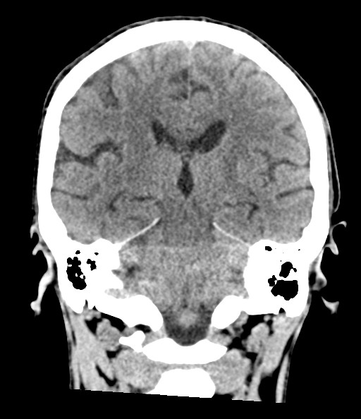 Acute superior cerebellar artery territory infarct (Radiopaedia 84104-99359 Coronal non-contrast 56).jpg