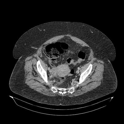 Acute superior mesenteric artery occlusion (Radiopaedia 51288-56960 Axial C+ portal venous phase 84).jpg