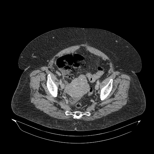 Acute superior mesenteric artery occlusion (Radiopaedia 51288-56960 Axial C+ portal venous phase 86).jpg