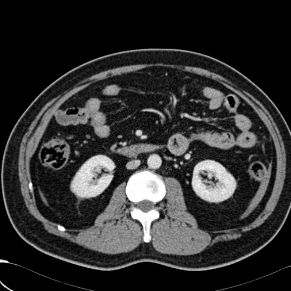 File:Acute traumatic mesenteric bleed (Radiopaedia 37561-39428 Axial C+ portal venous phase 77).jpg