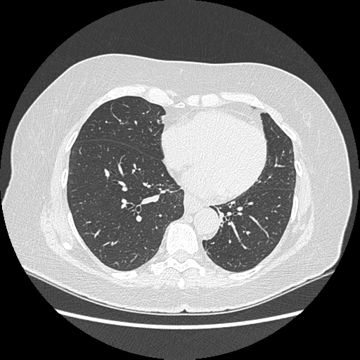Adenocarcinoma in situ of lung (Radiopaedia 38685-40829 B 146).png