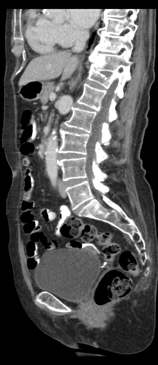Adenocarcinoma of cecum (Radiopaedia 59222-66549 Sagittal C+ portal venous phase 48).jpg