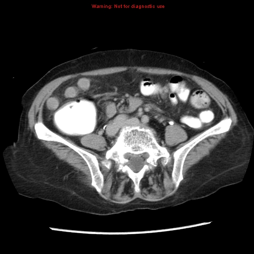 File:Adenocarcinoma of the colon (Radiopaedia 8191-9039 Axial renal excretory phase 35).jpg