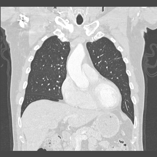 Adenocarcinoma of the lung (Radiopaedia 59871-67325 Coronal lung window 16).jpg