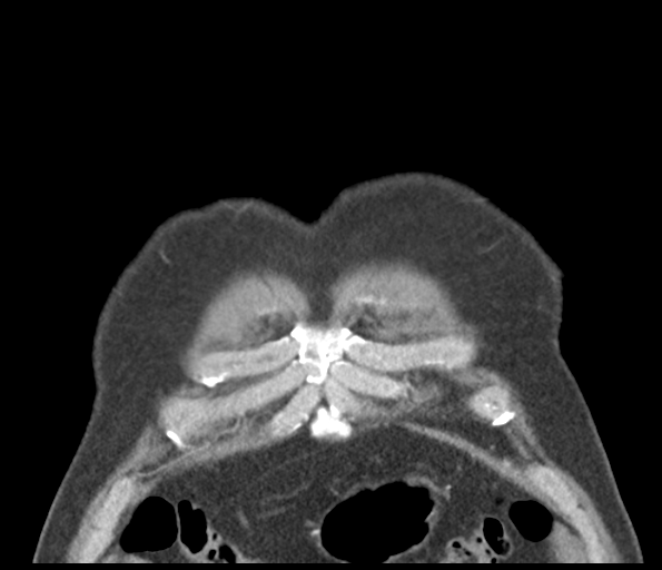 Adenocarcioma of rectum- T1 lesion (Radiopaedia 36921-38547 Coronal C+ arterial phase 9).png