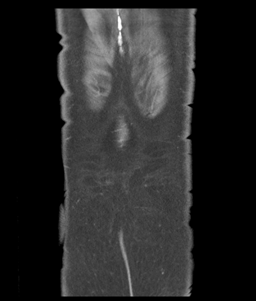 Adenocarcioma of rectum- T1 lesion (Radiopaedia 36921-38547 Coronal C+ portal venous phase 61).png