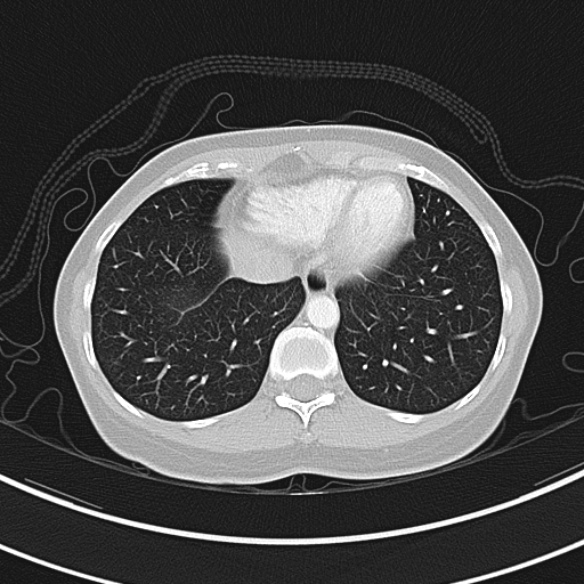 Adenocystic carcinoma of the trachea (Radiopaedia 47677-52525 Axial lung window 69).jpg