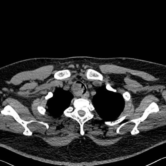 Adenoid cystic carcinoma of the trachea (Radiopaedia 49042-54137 Axial non-contrast 36).jpg