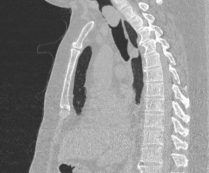 Adenoid cystic carcinoma of the trachea (Radiopaedia 49042-54137 Sagittal lung window 229).jpg