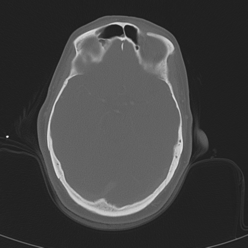 Adenoid cystic tumor of palate (Radiopaedia 46980-51518 Axial bone window 8).png