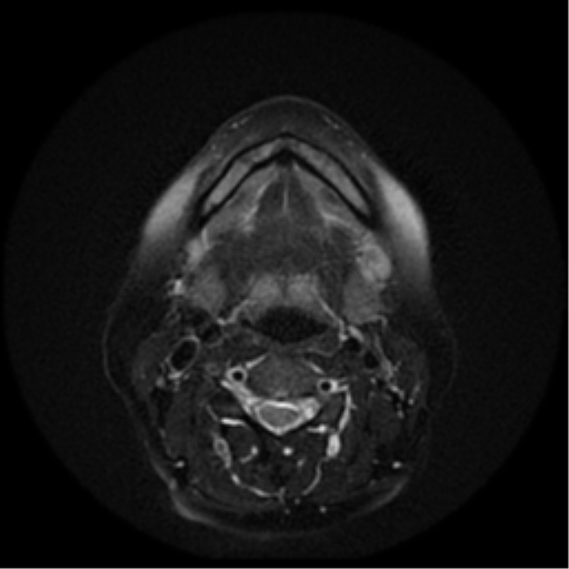 File:Adenoid cystic tumor of palate (Radiopaedia 46980-51519 Axial T2 11).png