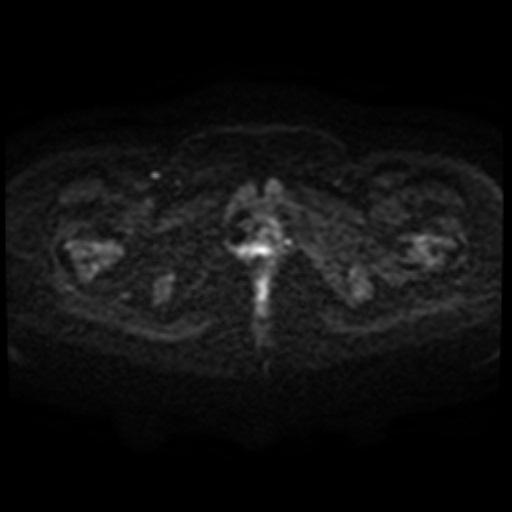 Adenoma malignum of cervix (Radiopaedia 66441-75705 Axial DWI 97).jpg
