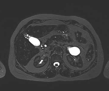 File:Adenomyomatosis of the gallbladder (Radiopaedia 50246-55587 Axial 51).png