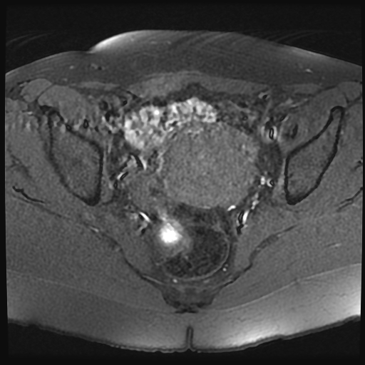 File:Adenomyosis-scar endometriosis (Radiopaedia 65863-75022 Axial T1 fat sat 15).jpg