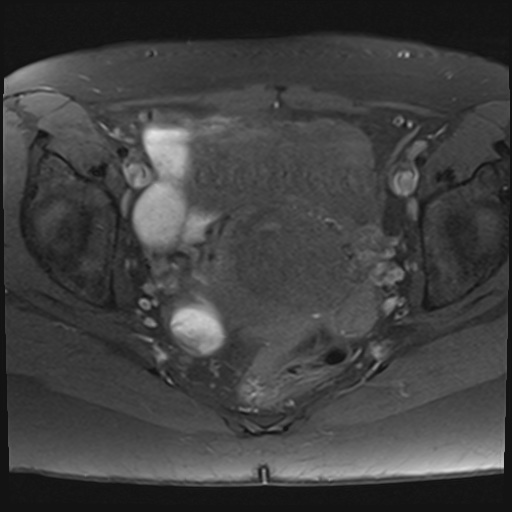 File:Adenomyosis and endometriotic cysts (Radiopaedia 82300-96367 Axial T1 fat sat 10).jpg