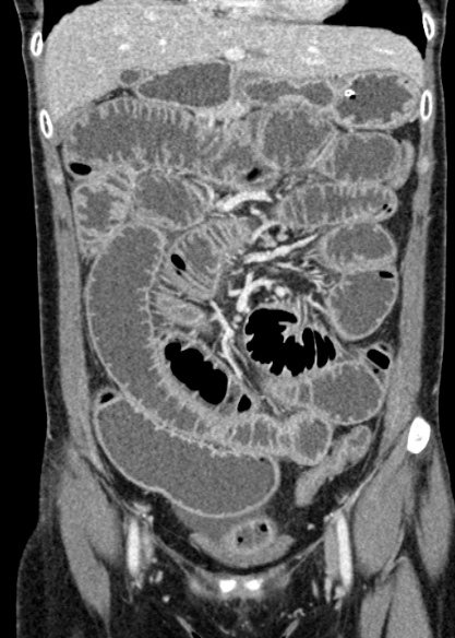 File:Adhesional small bowel obstruction (Radiopaedia 48397-53305 Coronal C+ portal venous phase 118).jpg