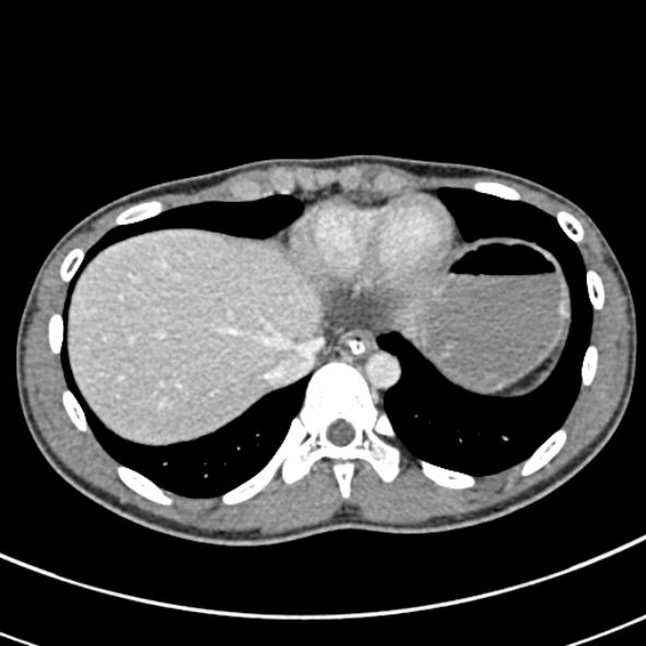 File:Adhesional small bowel obstruction (Radiopaedia 52107-57980 Axial C+ portal venous phase 10).jpg