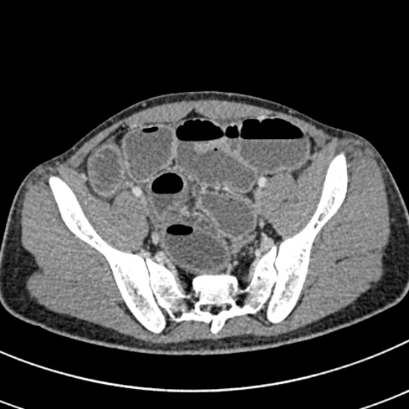Adhesional small bowel obstruction (Radiopaedia 52107-57980 Axial C+ portal venous phase 101).jpg