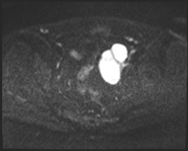 Adnexal multilocular cyst (O-RADS US 3- O-RADS MRI 3) (Radiopaedia 87426-103754 Axial DWI 43).jpg