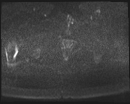 Adnexal multilocular cyst (O-RADS US 3- O-RADS MRI 3) (Radiopaedia 87426-103754 Axial DWI 85).jpg