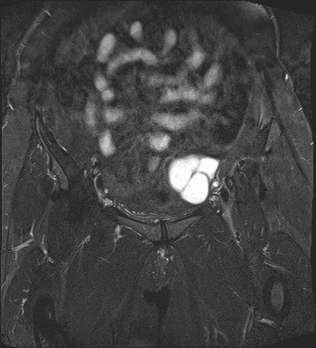 File:Adnexal multilocular cyst (O-RADS US 3- O-RADS MRI 3) (Radiopaedia 87426-103754 Coronal T2 fat sat 9).jpg