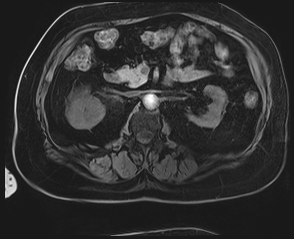 Adrenal cortical carcinoma (Radiopaedia 64017-72770 Axial T1 C+ fat sat 21).jpg