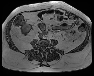 File:Adrenal cortical carcinoma (Radiopaedia 64017-72770 Axial T1 out-of-phase 60).jpg